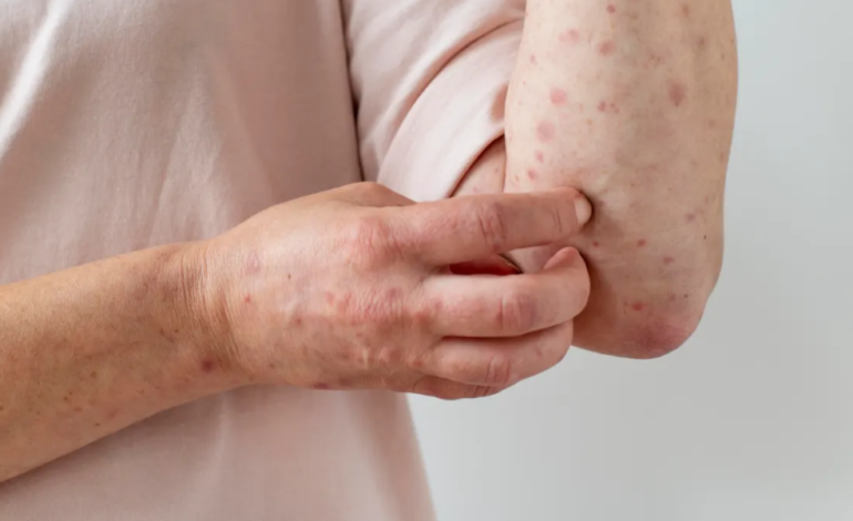 El sarampión se extiende a nueve estados de EEUU, la mayoría de los casos en no vacunados.