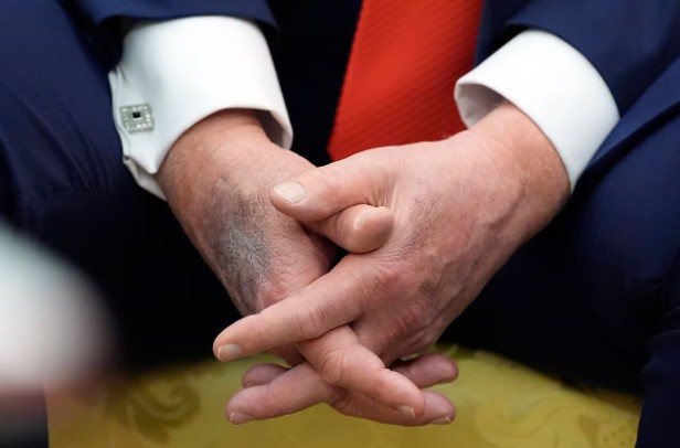 Preocupación por Trump: ¿qué ocurre con su mano?